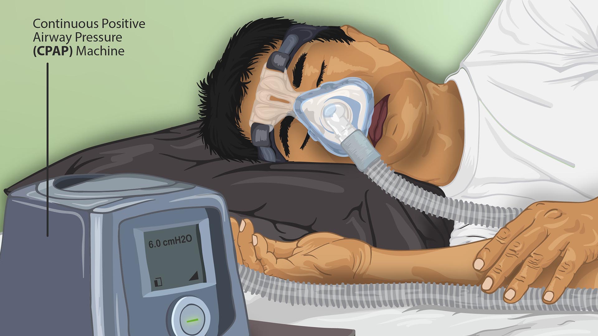Depiction of a sleep apnea patient using a CPAP machine
